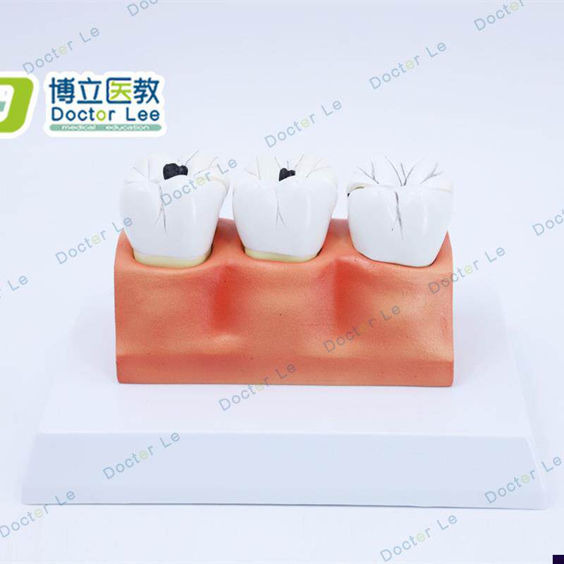 教学仿真龋齿模型牙齿模型病变牙齿模型3颗龋齿模型W龋齿分解模型