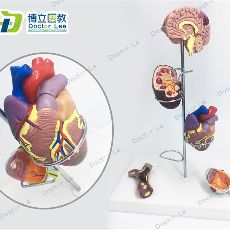 人体高血压模型高血压大脑心脏血管内科普外科X医生礼品大脑