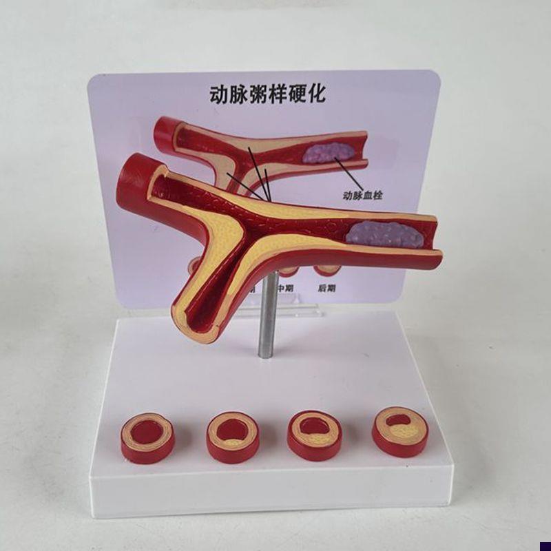 人体血管模型动脉血管结构冠状动脉D健康深静脉栓子临床医患血液