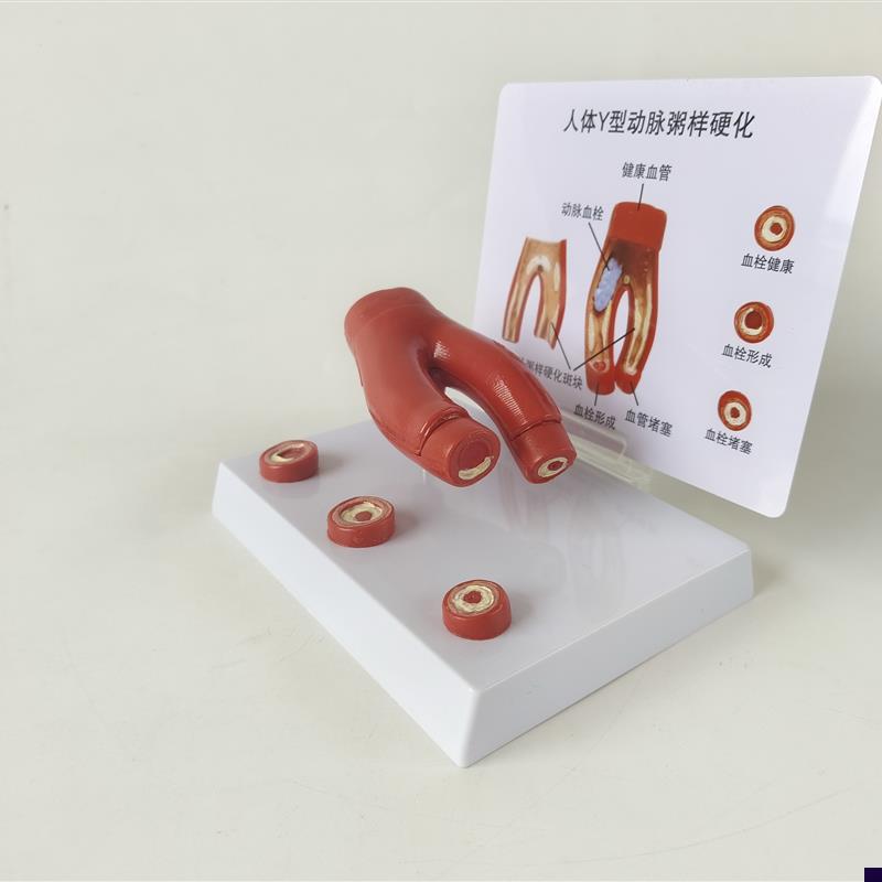 人体心脑血管f动脉粥样硬化堵塞模型血栓血液脂肪病理解剖医学教