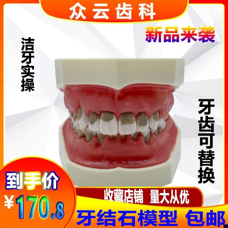 牙科口腔练习牙结石龈上龈下刮治模型牙结O石牙周病理牙齿模型