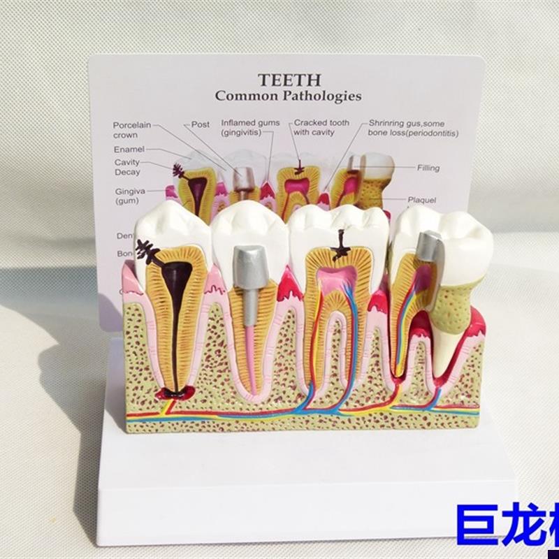 正品牙齿常见g病组合模型人体模型内脏口腔医学教具蛀牙牙齿