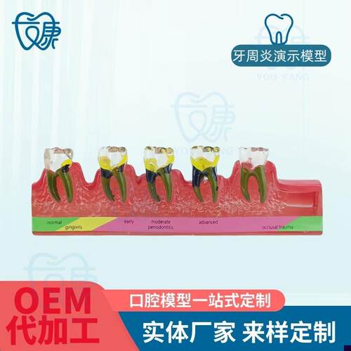 牙科口腔教学模型牙周炎模型牙周炎L演变模型牙科口腔教具