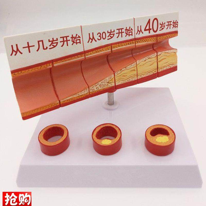 动脉血管模e型不同年龄段血管内膜变化粥样硬化栓子血管狭窄斑块