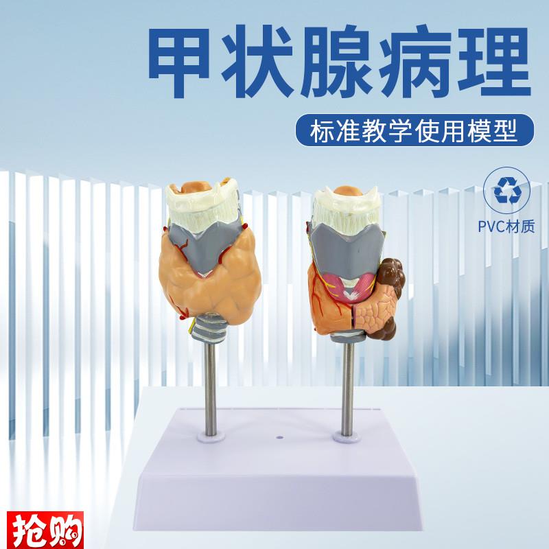 教学仿真人体甲状腺病理模型甲亢模型病态甲状腺模型.甲状腺结节