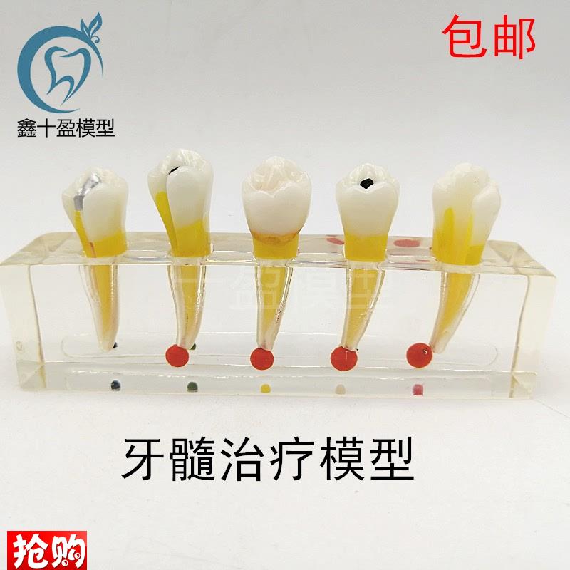 牙科口腔a牙齿模型牙髓修复模型前磨牙牙体蛀牙根管龋坏M4007-2