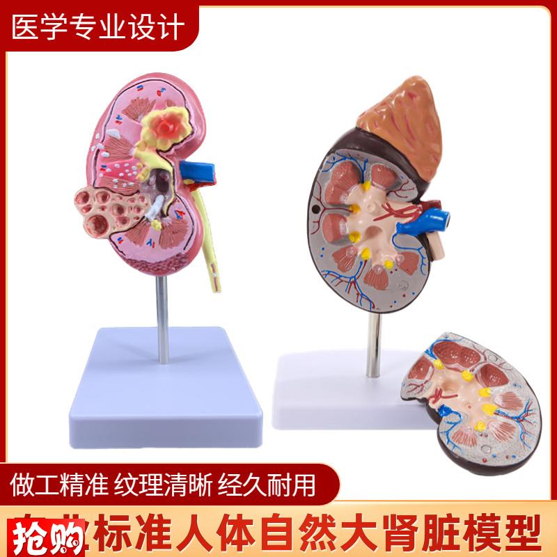 人体肾解剖模型i正常肾部模型,病理肾脏模型专业内脏器官医学教具