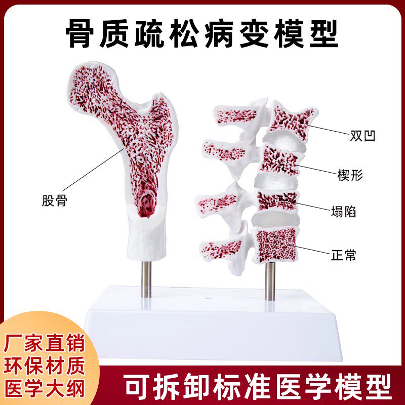 仿真人体骨质疏松k骨骼股骨头脊椎双凹塌陷楔形病理变正常教学模