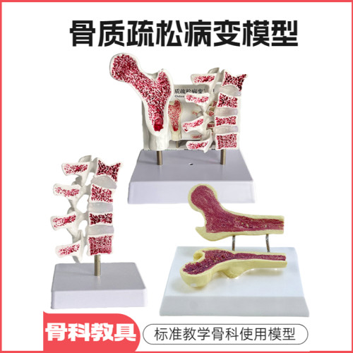 人体股骨骨质疏松解剖模型腿骨解剖面 脊柱切O面标本 病变腰椎模