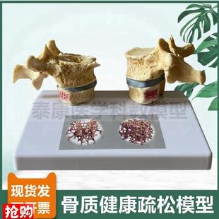 人体骨骼模型脊椎骨质密度疏松老年E人骨骼椎间盘压迫神经演示病
