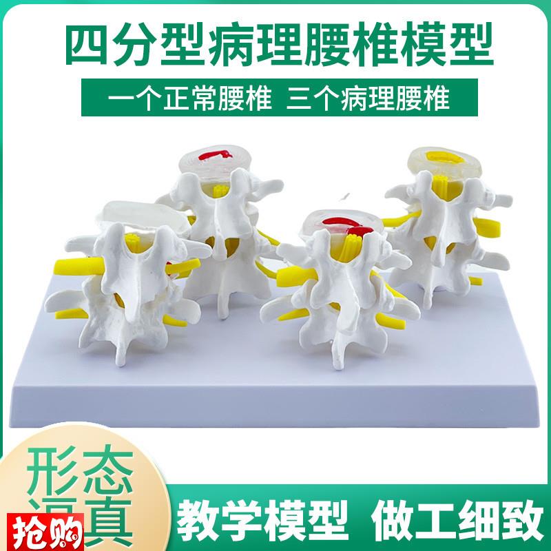 四分型脊椎c正常与病变腰椎组合模型椎间盘病理腰椎演示过程病变