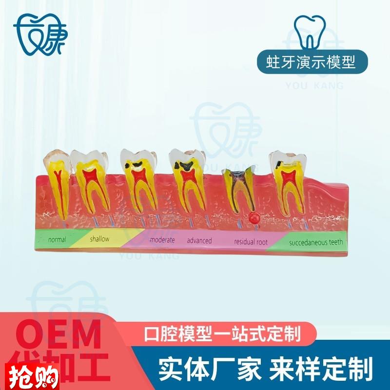 口腔教学模型牙科口腔牙u科蛀牙模型蛀牙演示模型蛀牙龋齿模型