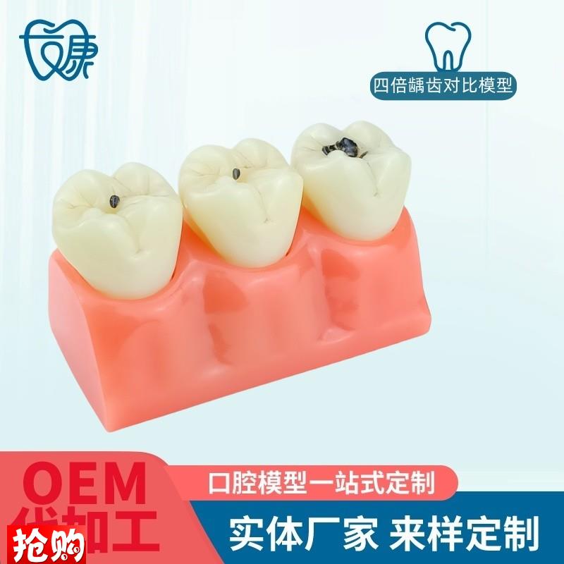 牙模型牙科口腔教学p模型窝沟封闭模型龋齿对比模型龋齿模型