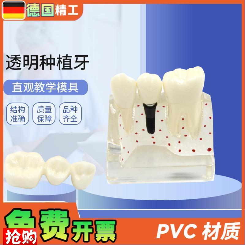 德国】透b明种植牙模型牙科修复模型透明可拆卸病理种植体牙