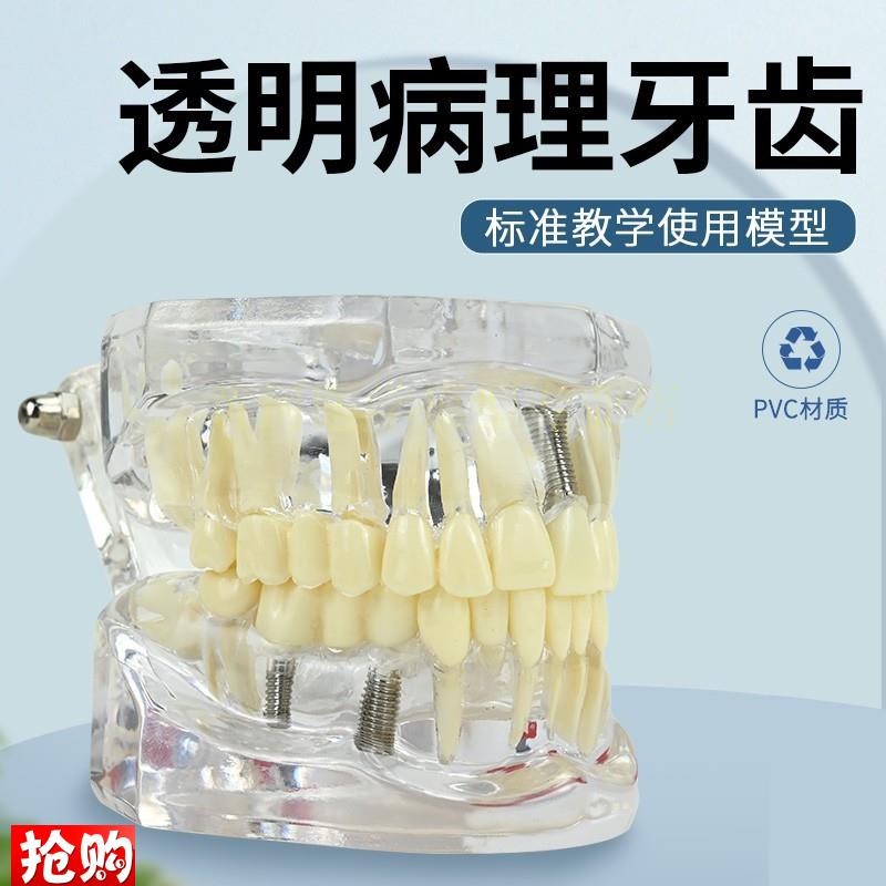 病理口腔模型牙齿模型模具早教刷牙牙模标准教具牙.医讲解模型