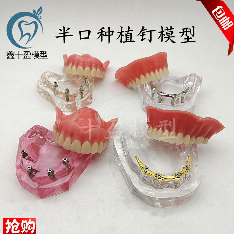 牙科模型医患沟通k2四4颗钉种植与修复模型种植钉球帽杆卡导板