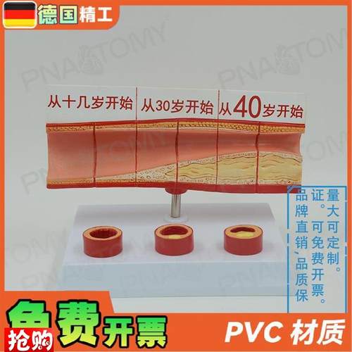 德国】人体动脉血管堵塞模型心脑血管血I栓/硬化模型教学心脑血管