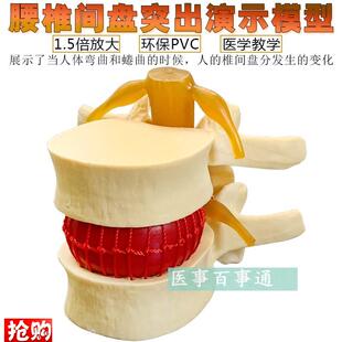 脊柱模型脊椎骨头腰椎间r盘模具椎体模型突出受压病理骨质教具包
