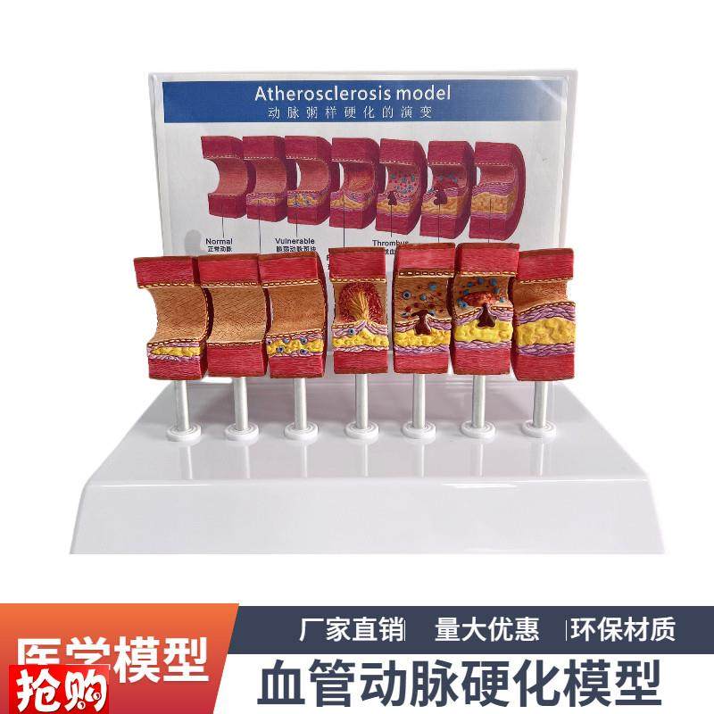 7节动脉粥样硬化模型血r管血栓栓塞演示模型人体血管模型医用教具