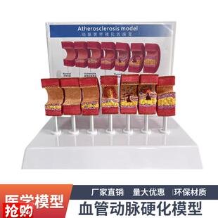 7节动脉粥样硬化模型血r管血栓栓塞演示模型人体血管模型医用教具