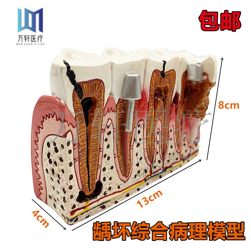 齿科口腔模型 h教学模型龋坏根管治疗及牙结石6倍综合病理展示模