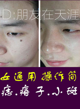 去痦子去除膏拾痦子膏无痕正品家用猴子肉痣神器祛脸上黑点黑痣