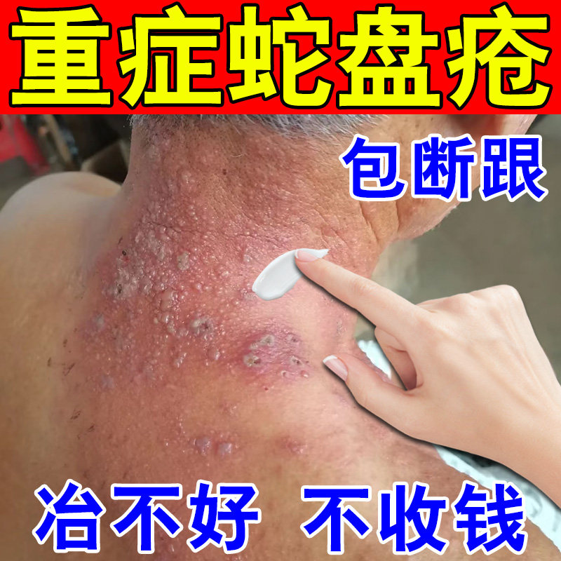 蛇盘疮专用膏药后遗症神经痛疼外用药带状疱泡疹蛇缠腰蛇胆疮克星