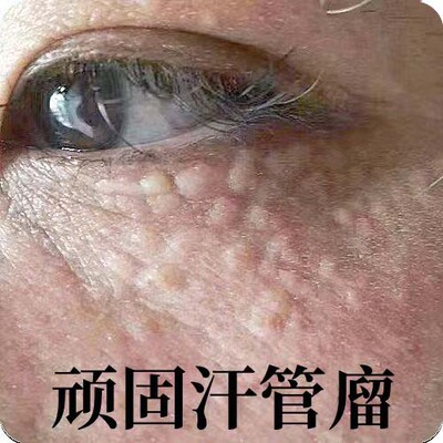 汗管-瘤眼部去除神器脂肪-粒扁平专用药膏眼周颗-粒油脂-粒去除