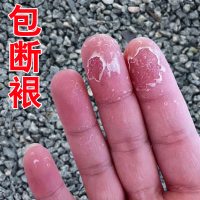 手干裂脱皮真菌感染严重脱皮专用