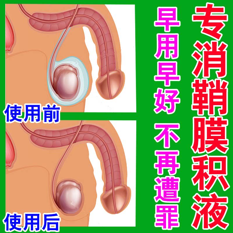 鞘膜积液药贴小儿鞘膜阴囊坠痛睾丸炎精索交通型积液成人疝气贴