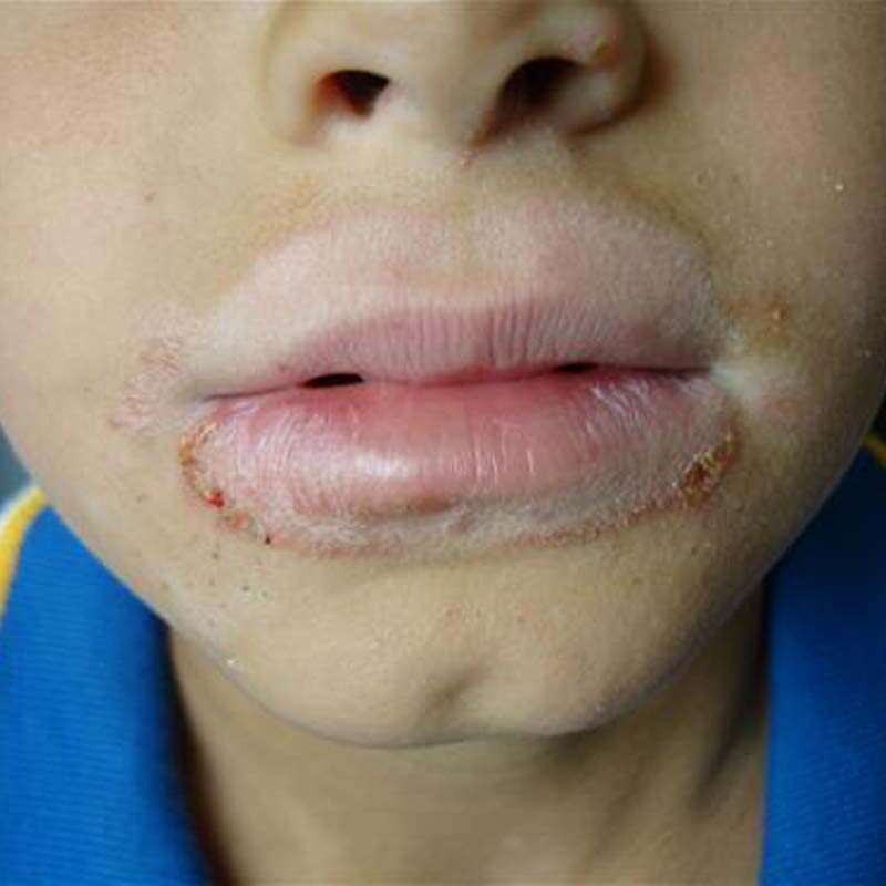 口周唇炎润唇膏儿童舔嘴唇干裂脱皮起皮唇膏嘴唇一圈红唇炎专用药