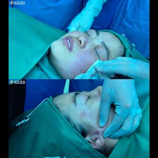 张宗学面部线雕纤维折叠面部提升苹果机复位皮瓣转移教学视频