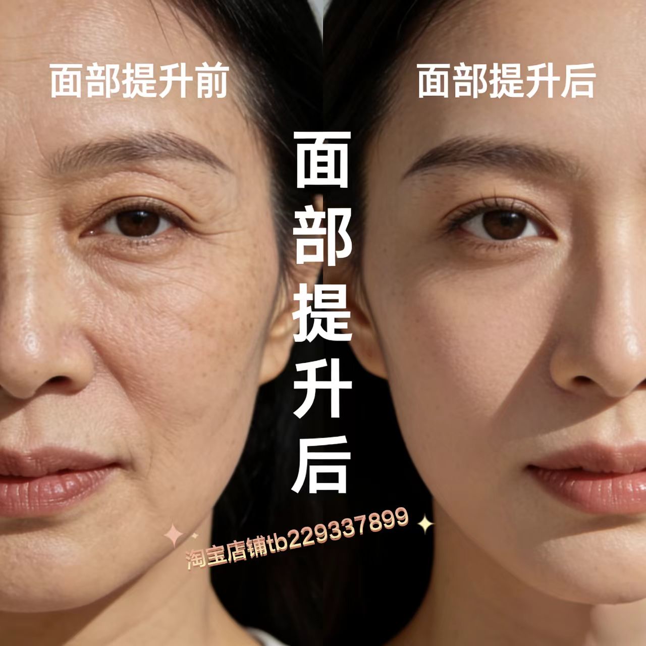骨线联合全面部提升艾维拉