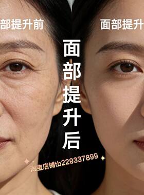 骨线联合全面部提升艾维拉