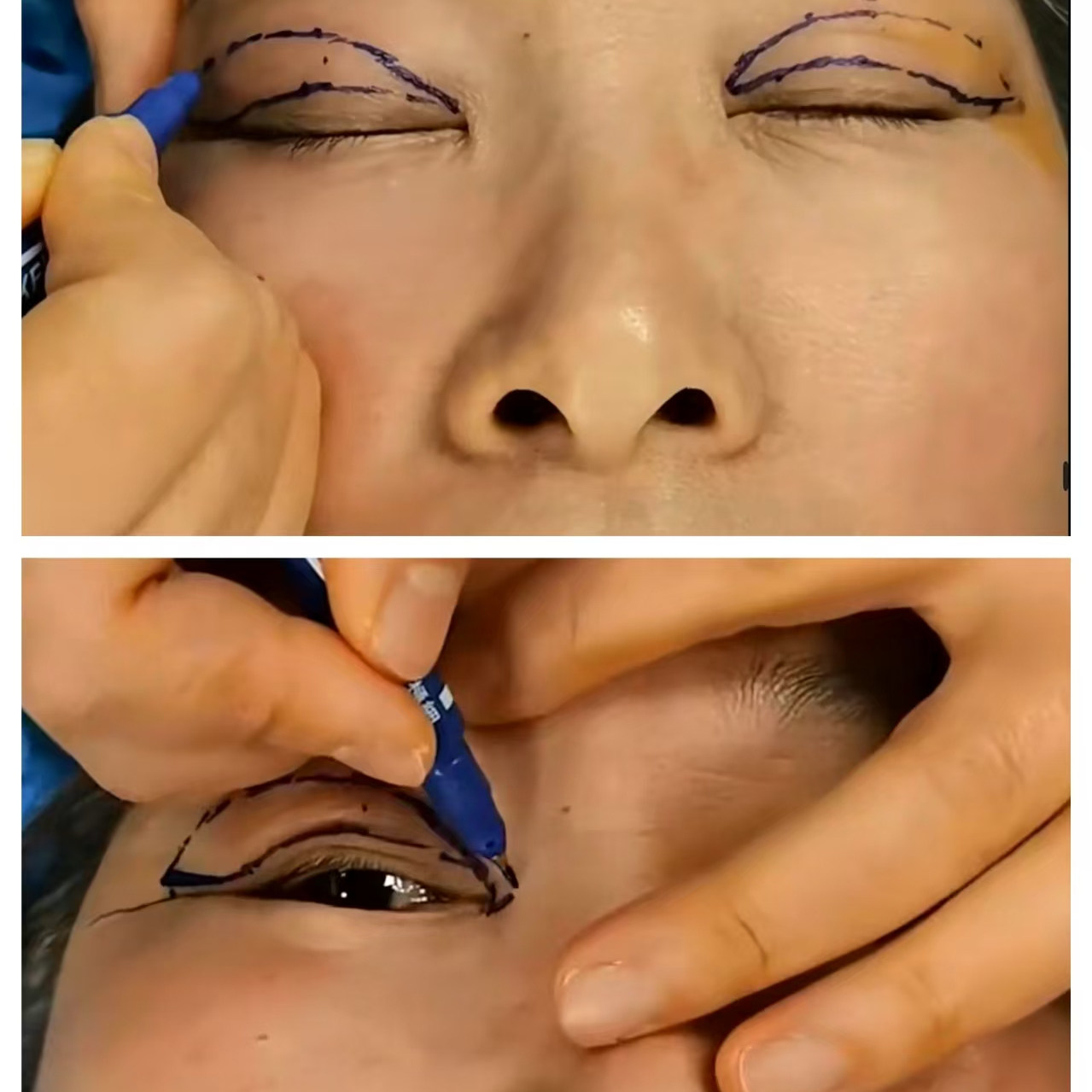 上睑皮肤松弛矫正重睑形态不佳