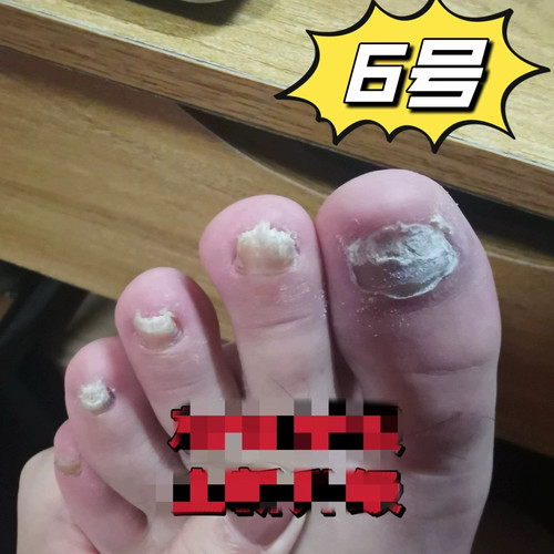 面先锋草本抑菌液不疼无需脱甲