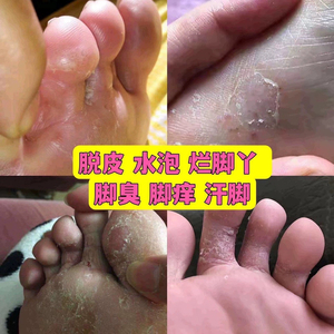 狼毒  1   买一送一脱皮 水泡 干裂 烂 jiao吖 jiao臭 汗