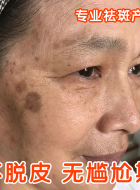 祛斑液分解黑色素不脱皮无尴尬期美容院去雀斑黄褐斑淡斑精华液