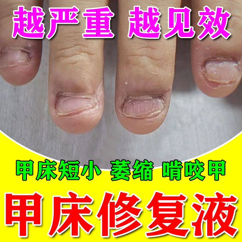 甲床修复生长液指甲受损萎缩断裂