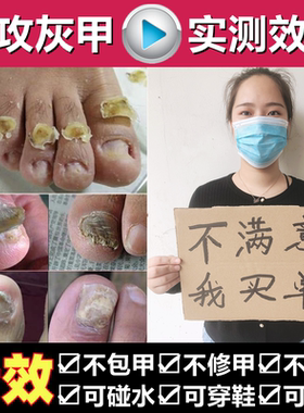 灰指甲药水特效专用凤仙花抑菌液软甲日本脱甲膏修甲刀进口药正品