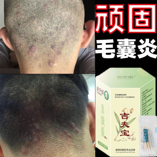 吉夫宝膏祛头面部毛囊炎疙瘩3送1