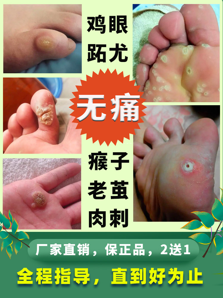 吉夫宝抑菌液无痛除鸡眼跖疣瘊子