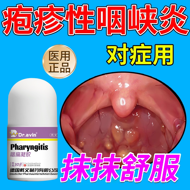 疱疹性咽峡炎喷雾儿童干扰素滤泡增生咽喉炎喷剂咽痛发热呕吐CA