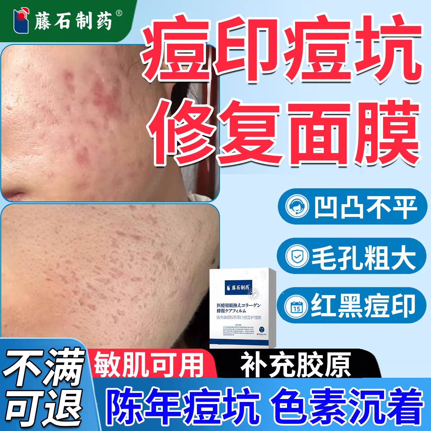 痘印痘坑修复去除精华面膜毛孔粗大专用抗炎消炎淡化祛痘印VX