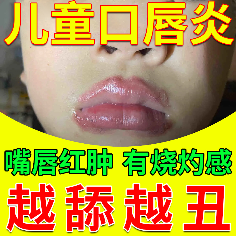 小孩儿童舌舔唇炎专用唇膏嘴唇防干裂脱皮嘴巴一圈红凝胶医用型CA