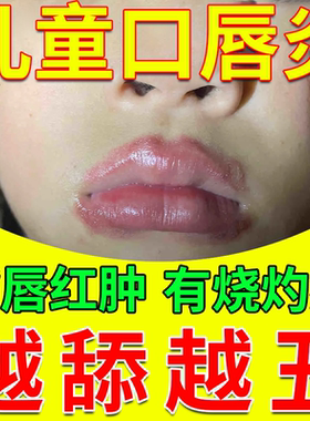 小孩儿童舌舔唇炎专用唇膏嘴唇防干裂脱皮嘴巴一圈红凝胶医用型CA