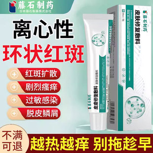 离心性环状红斑糜烂瘙痒皮肤多形性红斑止痒断铜钱癣外用抑菌膏SK