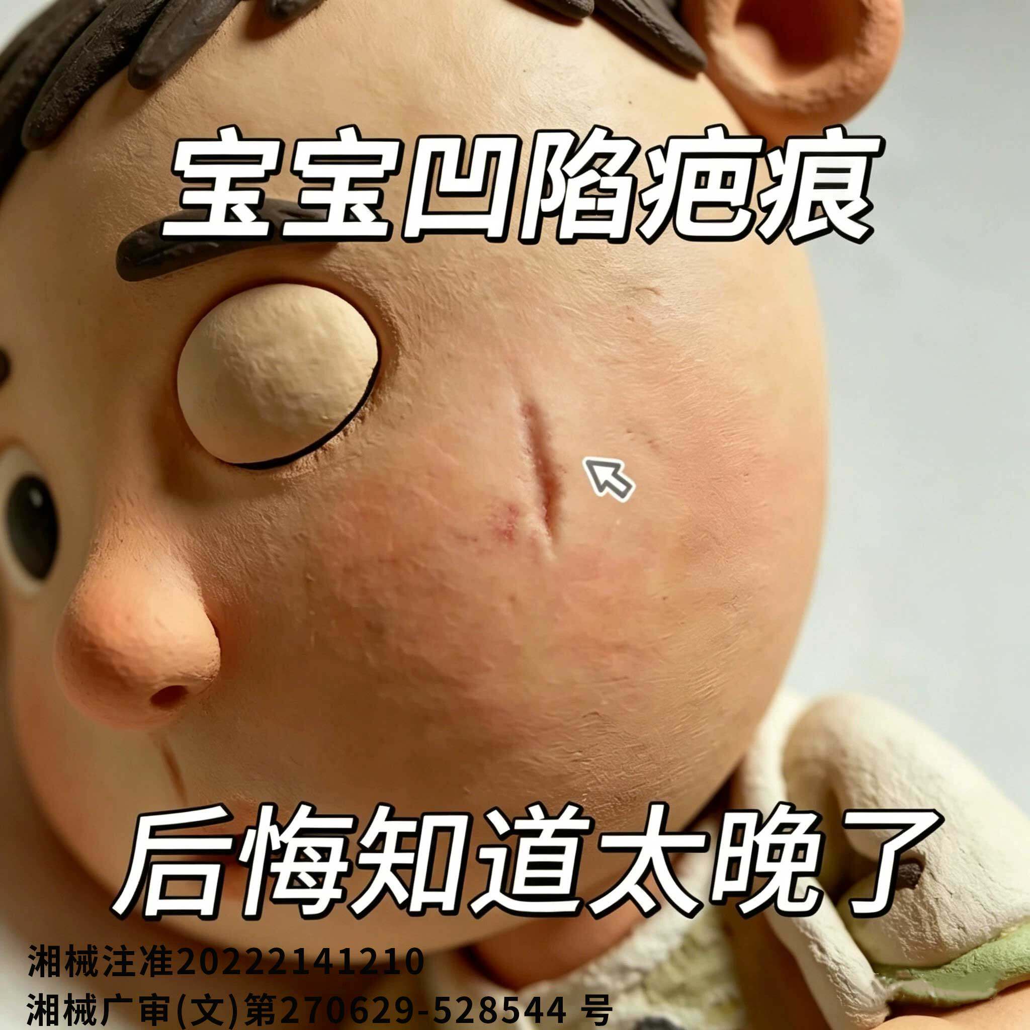 冯大夫代文儿童脸上凹陷疤痕修复凝胶摔擦伤痘坑痘印医用祛疤膏SA