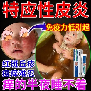 儿童特应性皮炎止痒去身体乳根皮肤瘙痒特异性宝宝湿疹泡澡包CA