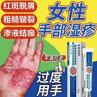 手部湿疹膏角化型手癣脱皮干裂中去真菌感染手指止痒药房同售VX